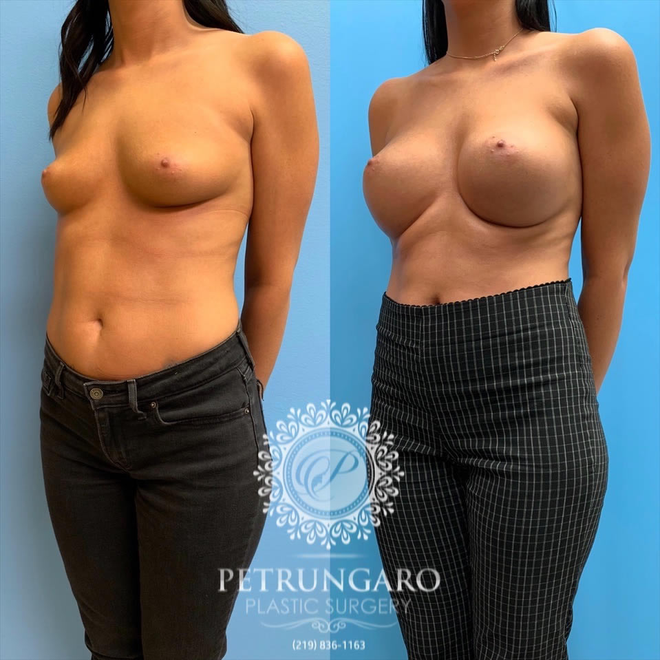 27-before-after-breast-implants-2
