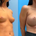 27-before-after-breast-implants-feature