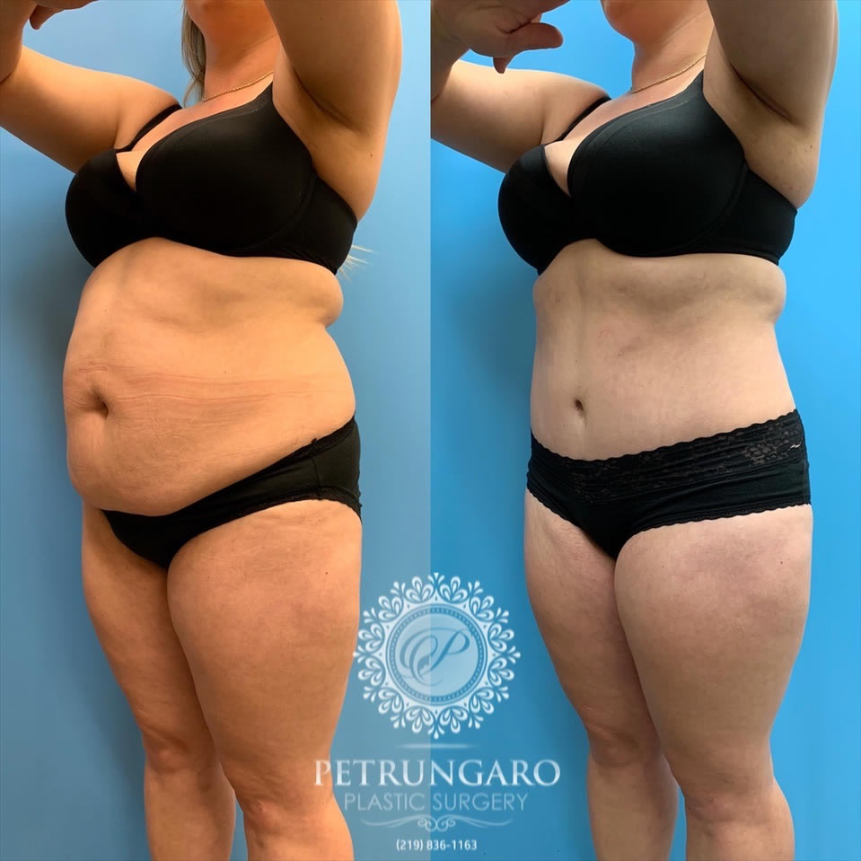 33-female-before-after-tummy-tuck-lipo-360-1