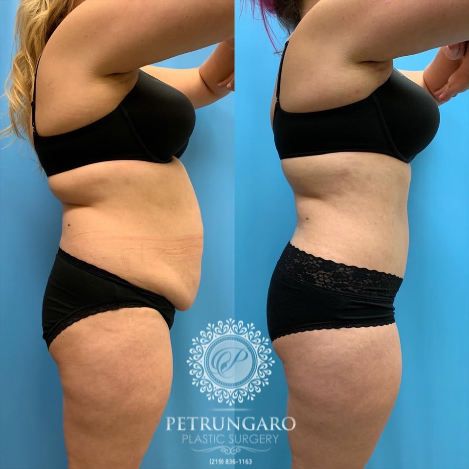 33-female-before-after-tummy-tuck-lipo-360-3