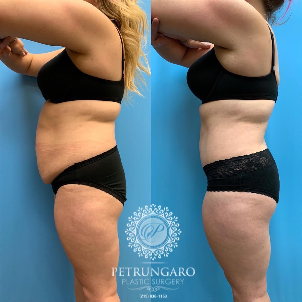 33-female-before-after-tummy-tuck-lipo-360-4
