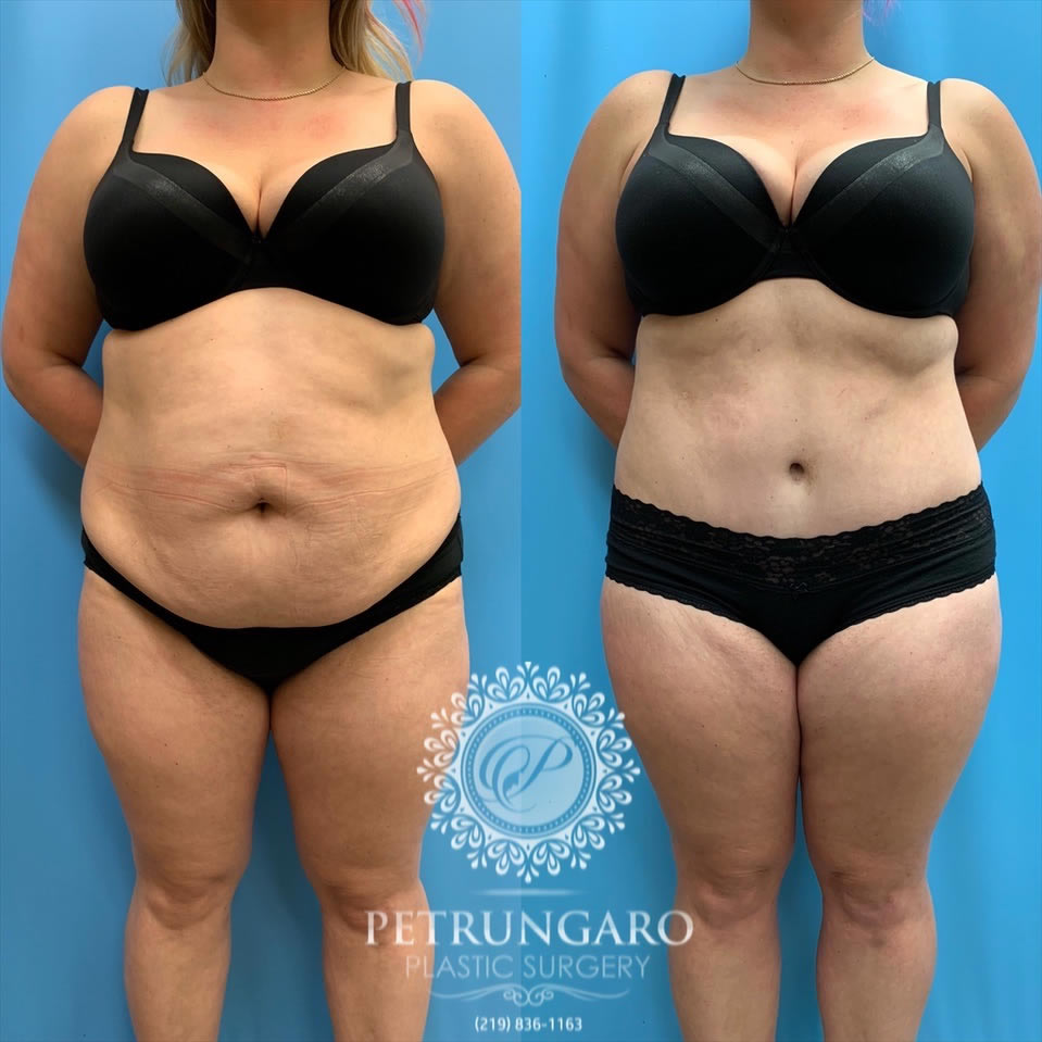 33-female-before-after-tummy-tuck-lipo-360-5