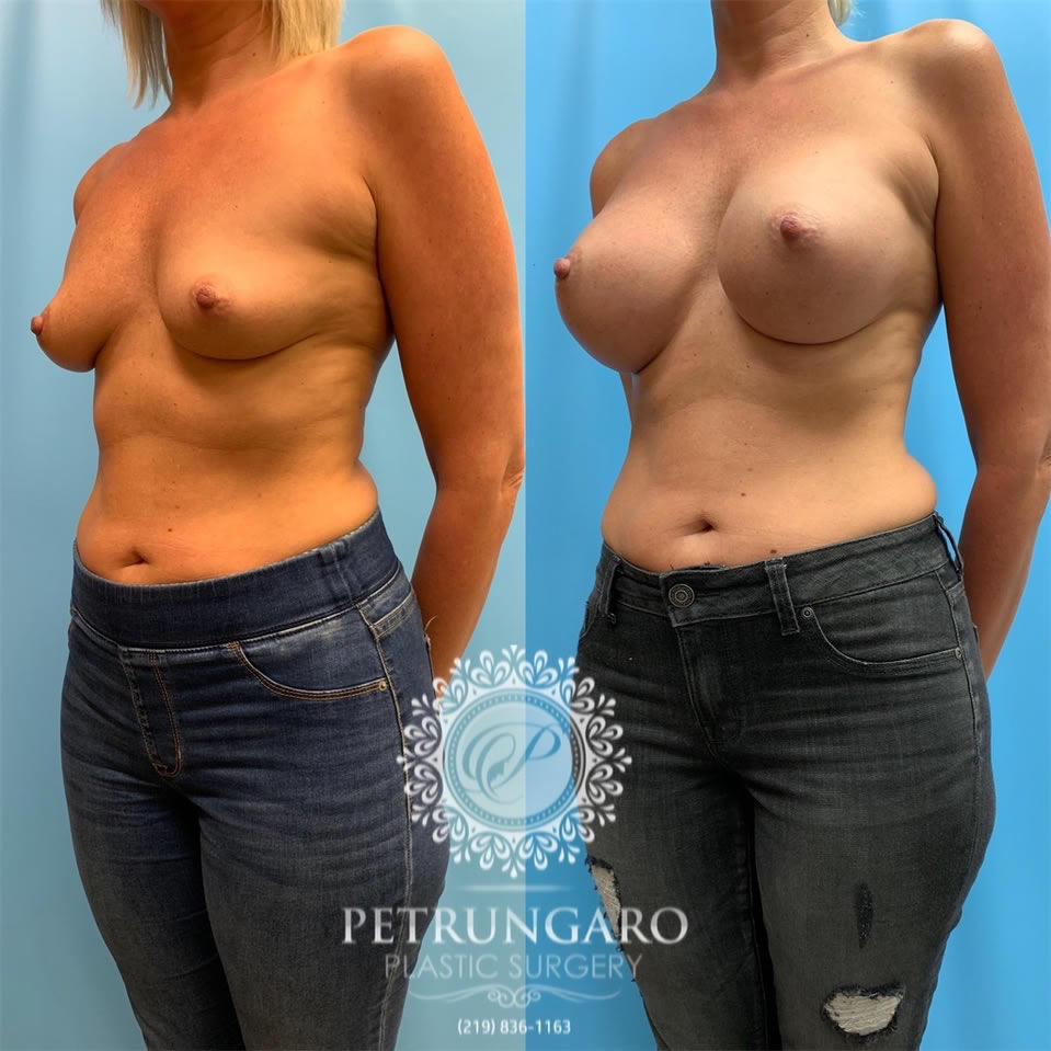 40-before-after-breast-augmentation-implants-1