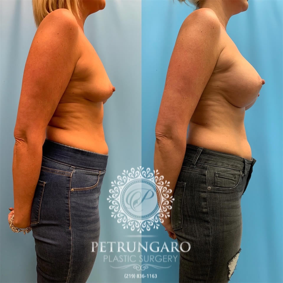 40-before-after-breast-augmentation-implants-3