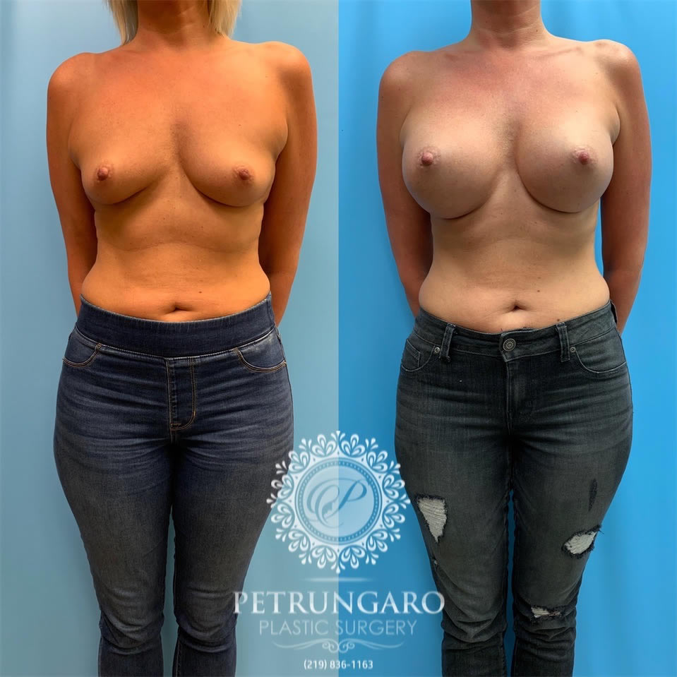 40-before-after-breast-augmentation-implants-5