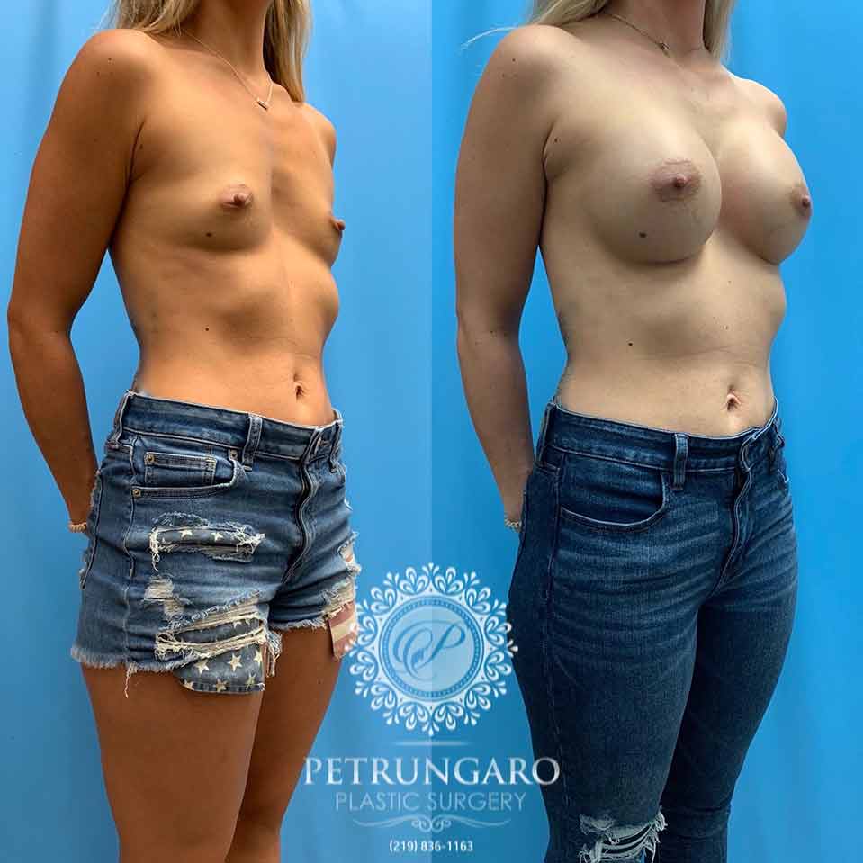 28-breast-augmentation-implants-3