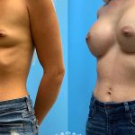 28-breast-augmentation-implants-feature