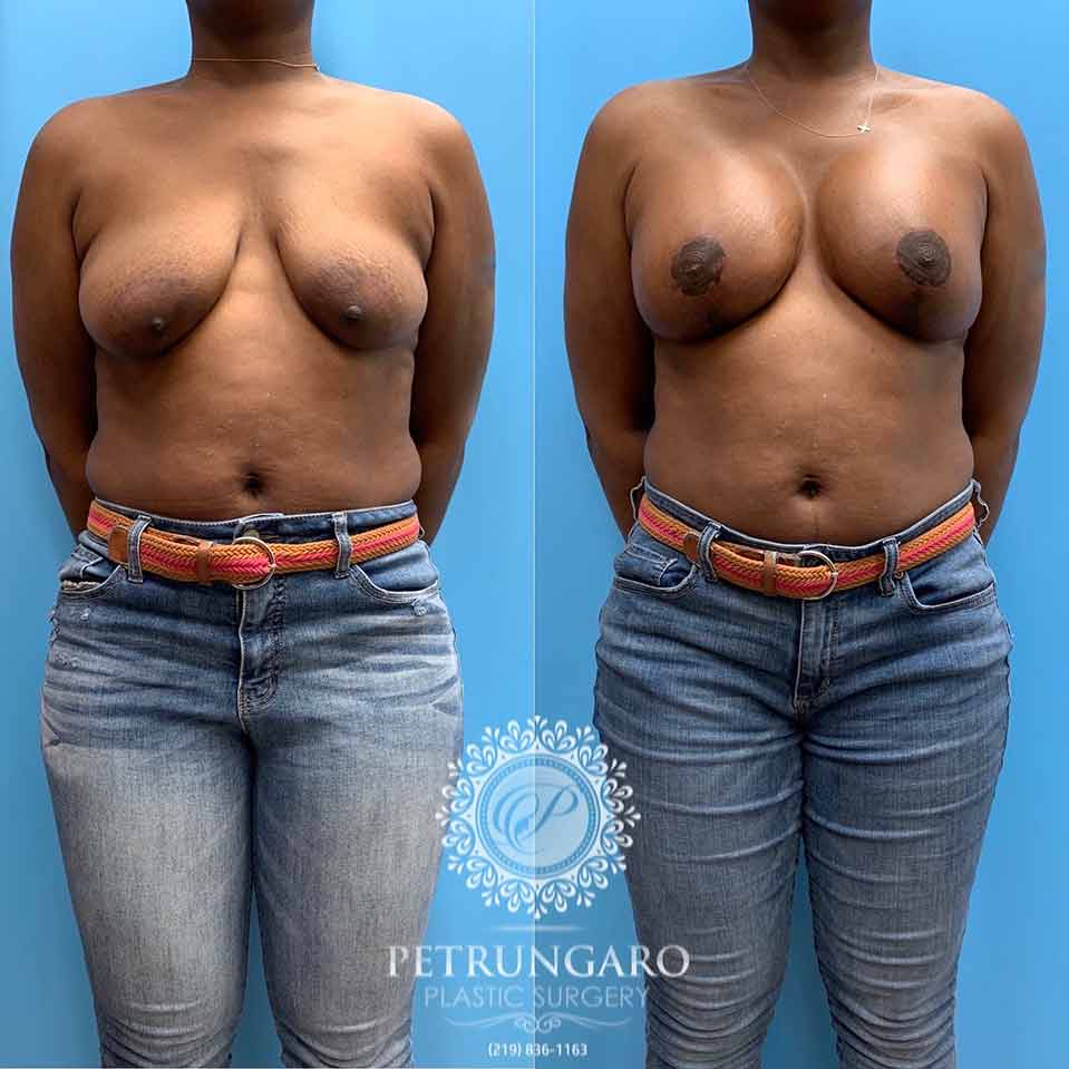 41-breast-lift-implants-1