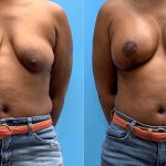 41-breast-lift-implants-feature