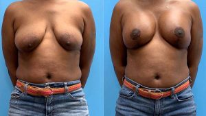 41-breast-lift-implants-feature