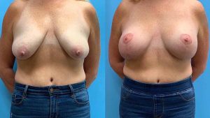 45-breast-lift-implants-feature