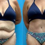 47-tummy-tuck-liposuction-feature