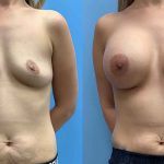 25-before-after-photos-breast-augmentation-feature-implants
