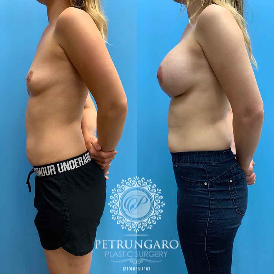 25-before-after-photos-breast-augmentation-implants-4