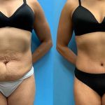 39-before-after-photos-tummy-tuck-feature