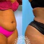 34-liposuction-360-featured