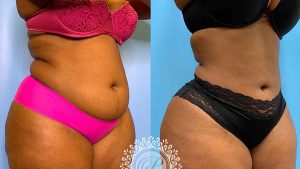 34-liposuction-360-featured