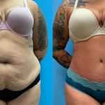 28 year old woman 3 months after Tummy Tuck with Lipo 360-f