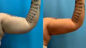 28 year old woman 3 months after liposuction of the upper arms-f