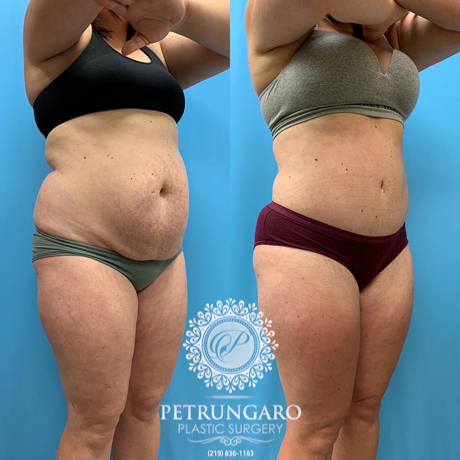 31 year old woman 5 months after Tummy Tuck with Lipo 360-4