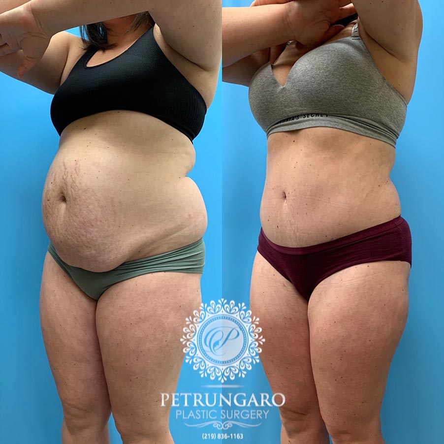 31 year old woman 5 months after Tummy Tuck with Lipo 360-5