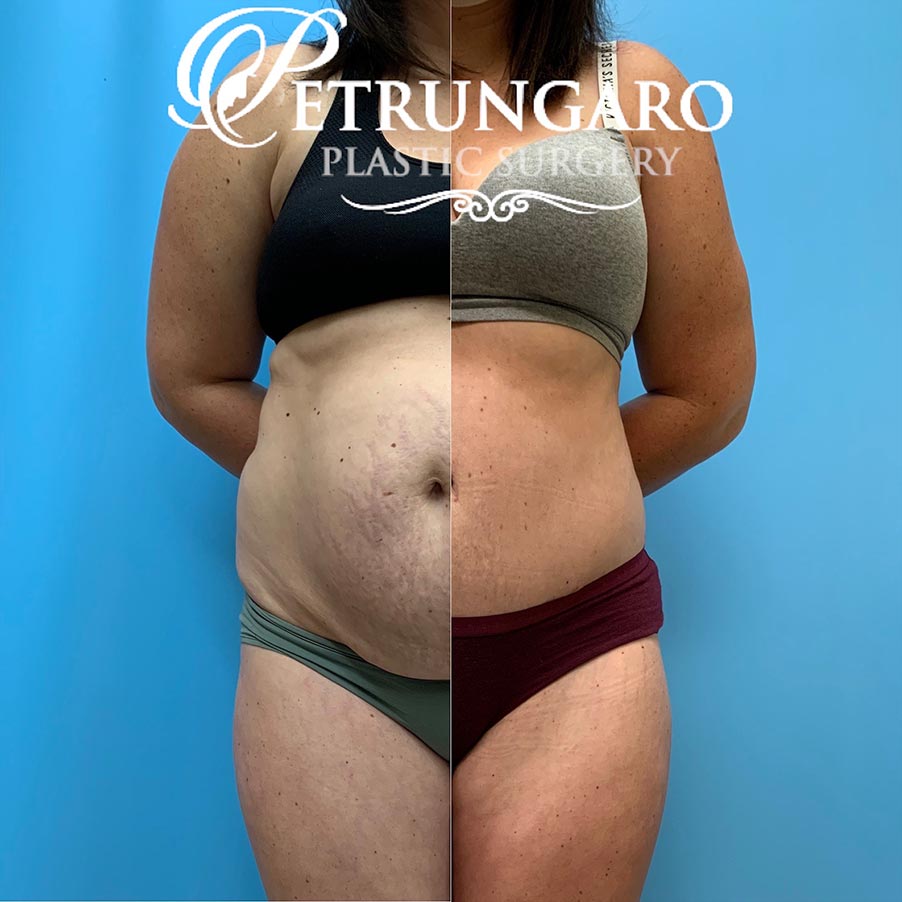 31 year old woman 5 months after Tummy Tuck with Lipo 360-7