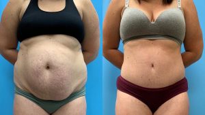 31 year old woman 5 months after Tummy Tuck with Lipo 360-f