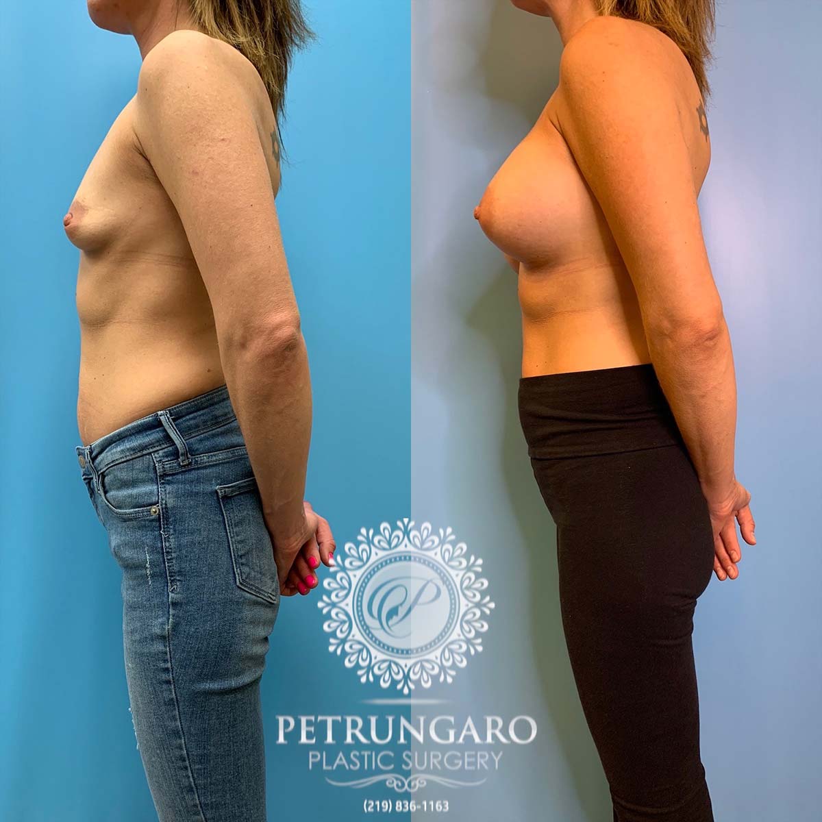 37 year old woman 3 months after breast augmentation-2
