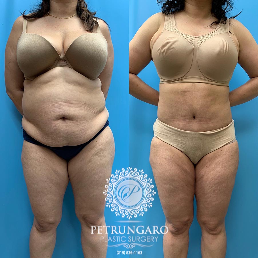 39 year old woman 4 months after Tummy Tuck with Lipo 360-1