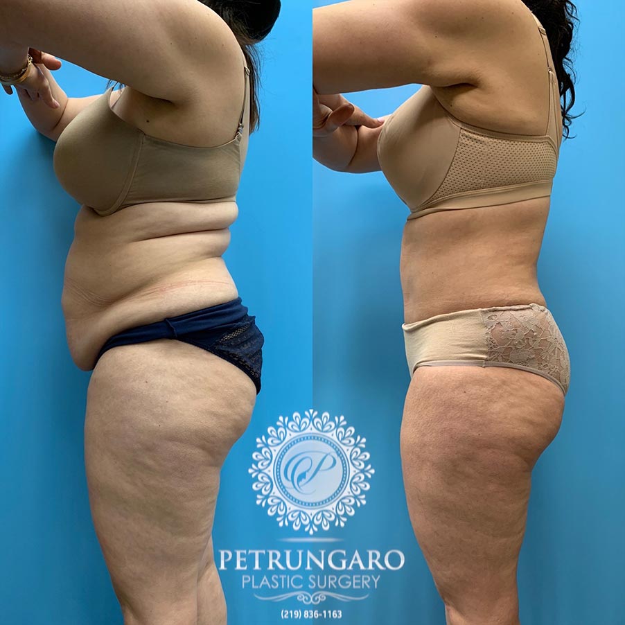 39 year old woman 4 months after Tummy Tuck with Lipo 360-2