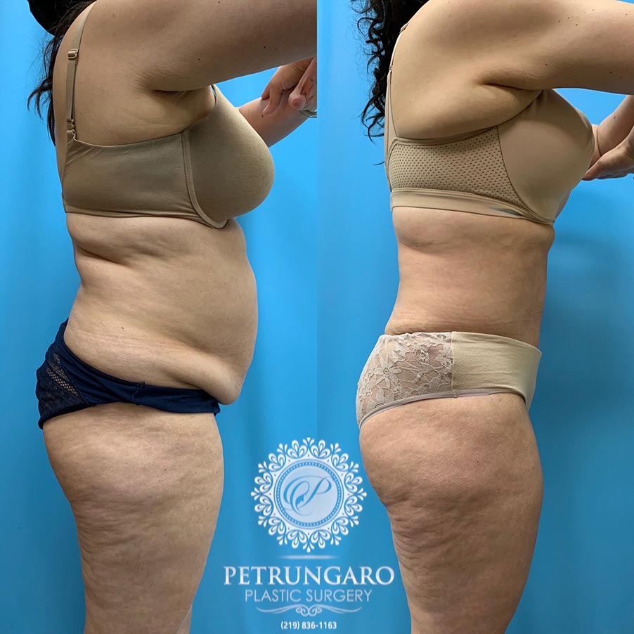 39 year old woman 4 months after Tummy Tuck with Lipo 360-3