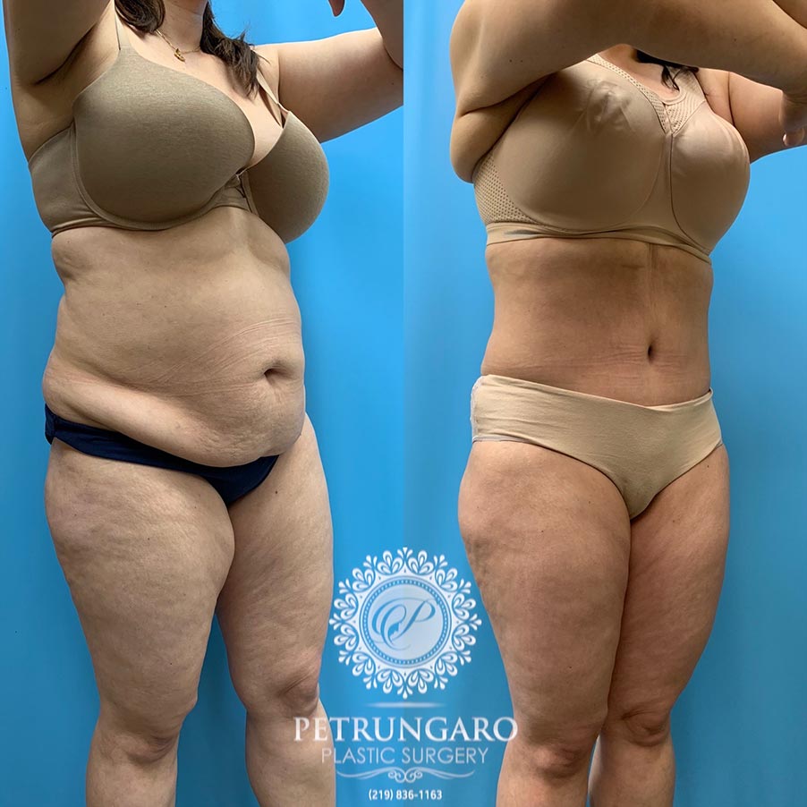 39 year old woman 4 months after Tummy Tuck with Lipo 360-4