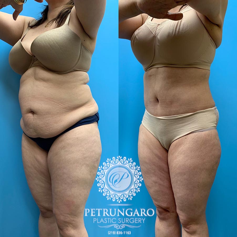 39 year old woman 4 months after Tummy Tuck with Lipo 360-5