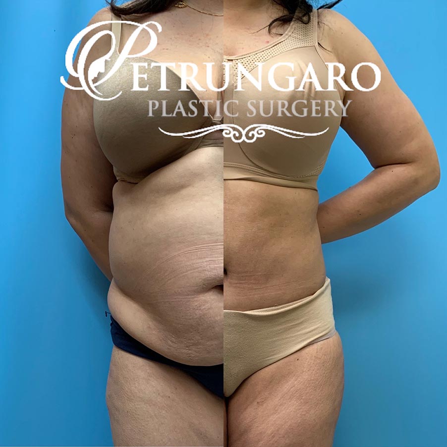 39 year old woman 4 months after Tummy Tuck with Lipo 360-6