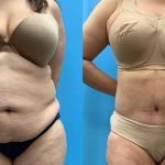 39 year old woman 4 months after Tummy Tuck with Lipo 360-f