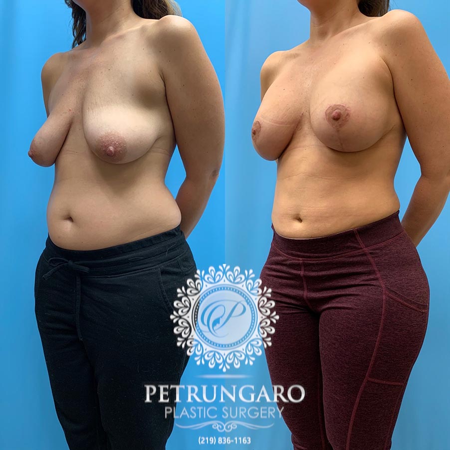 42 year old woman 3 months after Breast Lift with Implants-5