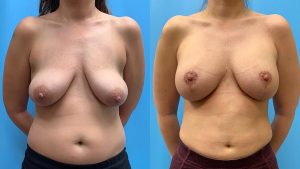 42 year old woman 3 months after Breast Lift with Implants-f