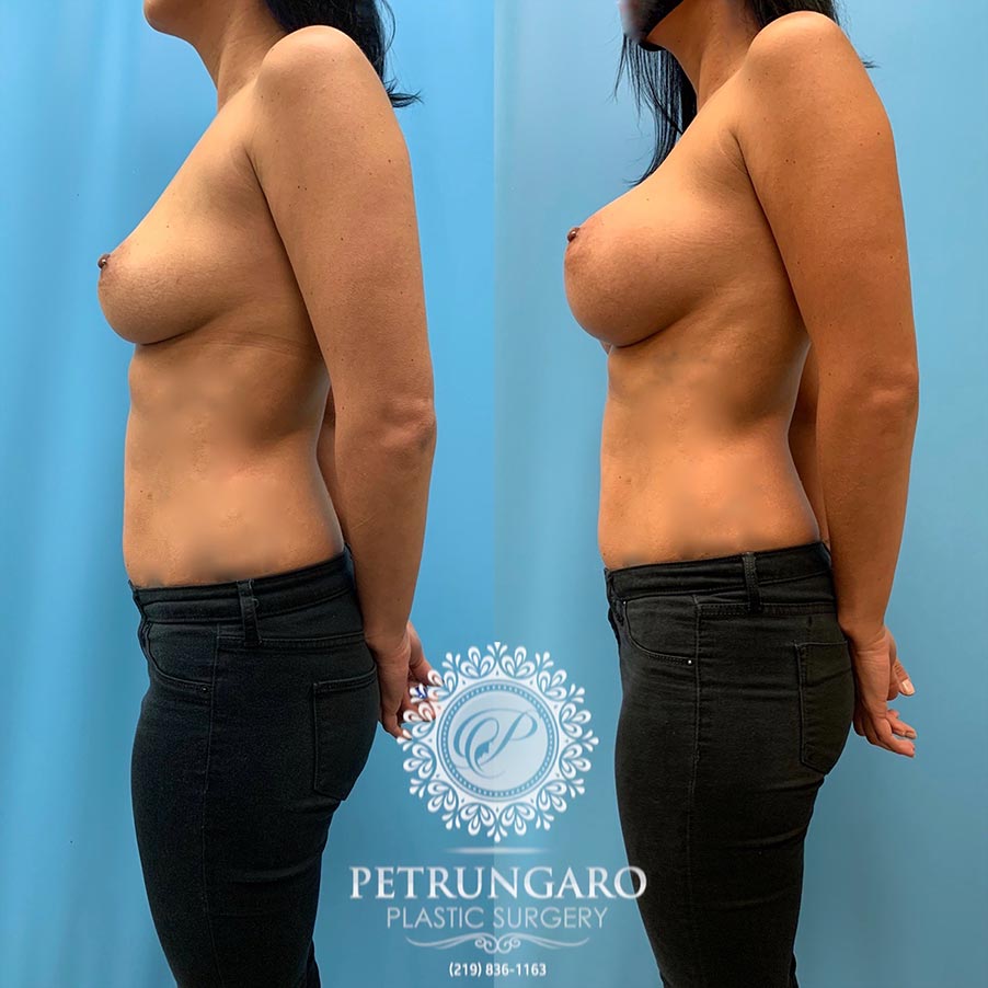 43 year old woman 3 months after Breast Augmentation-1