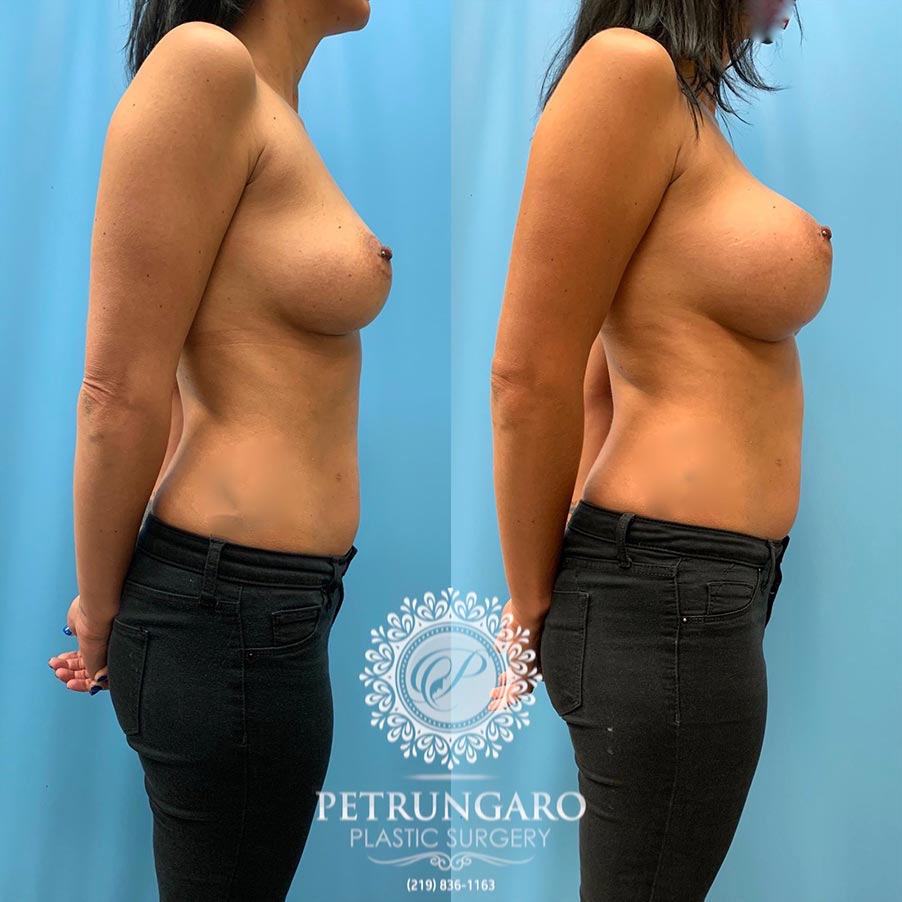 43 year old woman 3 months after Breast Augmentation-3