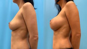 43 year old woman 3 months after Breast Augmentation-f