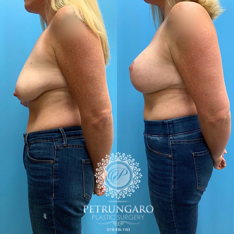 45 year old woman 3 months after Breast Lift with Implants-2