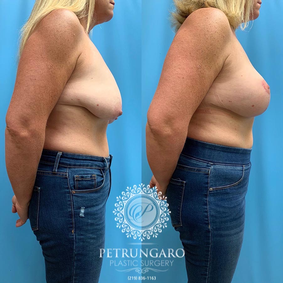 45 year old woman 3 months after Breast Lift with Implants-3