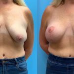 45 year old woman 3 months after Breast Lift with Implants-f
