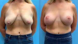 45 year old woman 3 months after Breast Lift with Implants-f