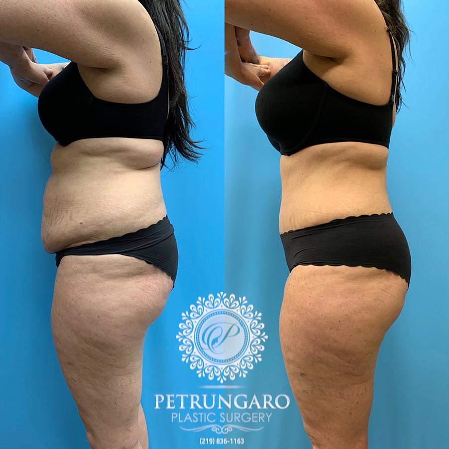 47 year old woman 4 months after Tummy Tuck with Lipo 360-2