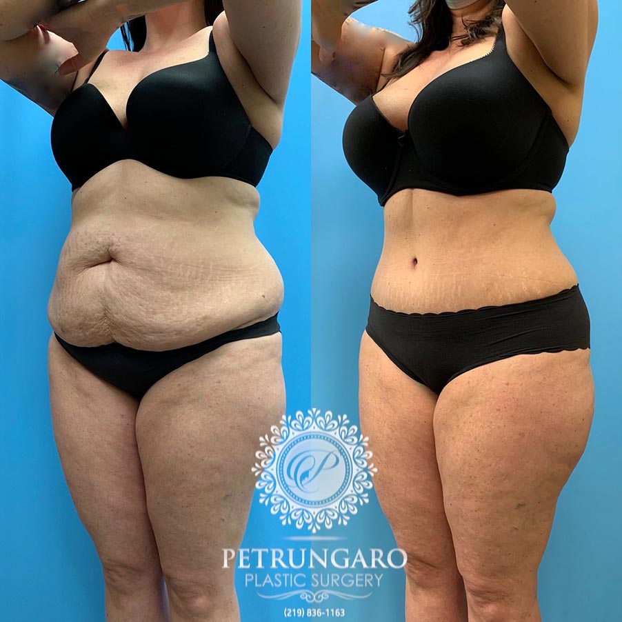 47 year old woman 4 months after Tummy Tuck with Lipo 360-5