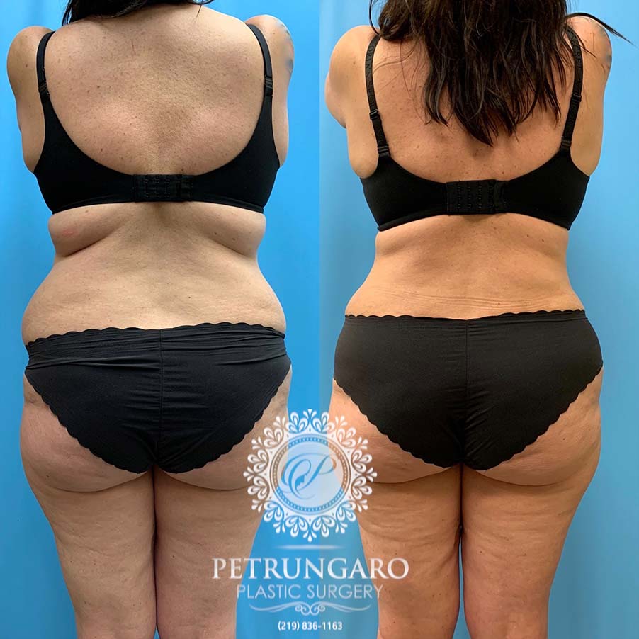 47 year old woman 4 months after Tummy Tuck with Lipo 360-6