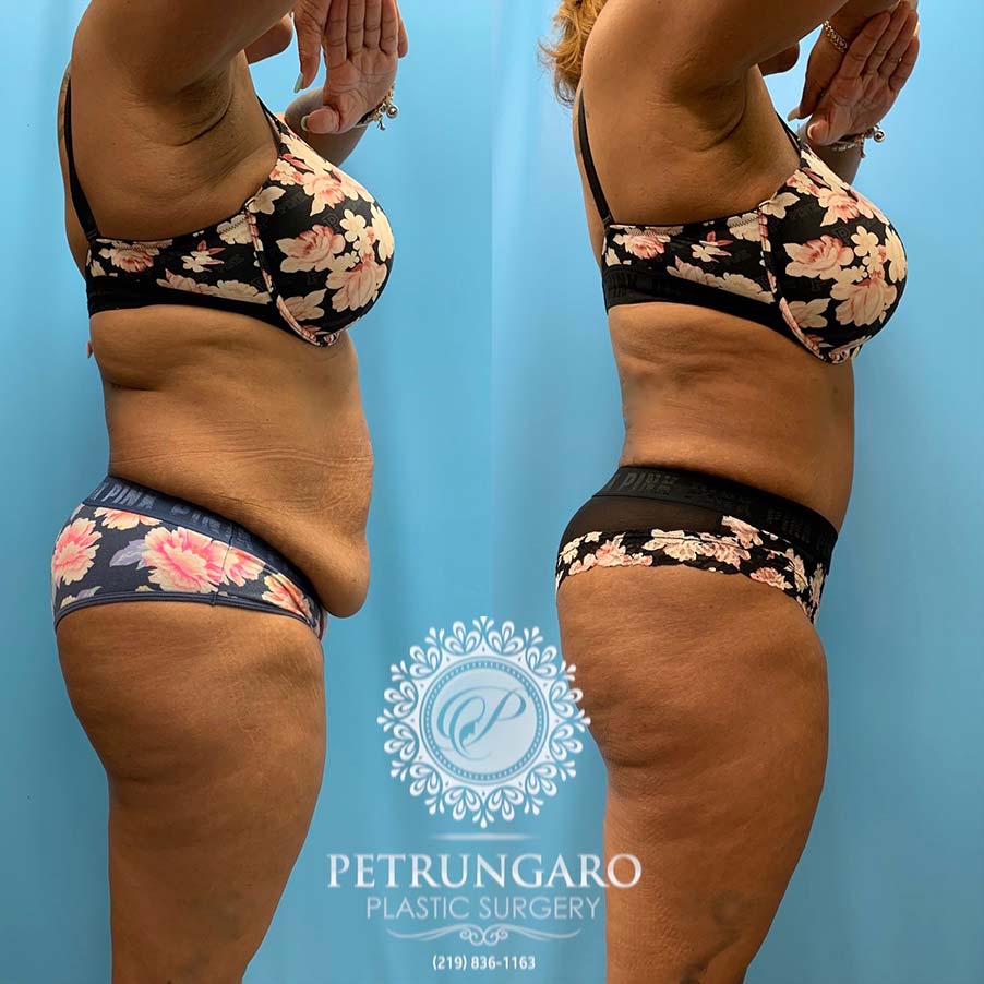 48 year old woman 4 months after Tummy Tuck with Lipo 360-5