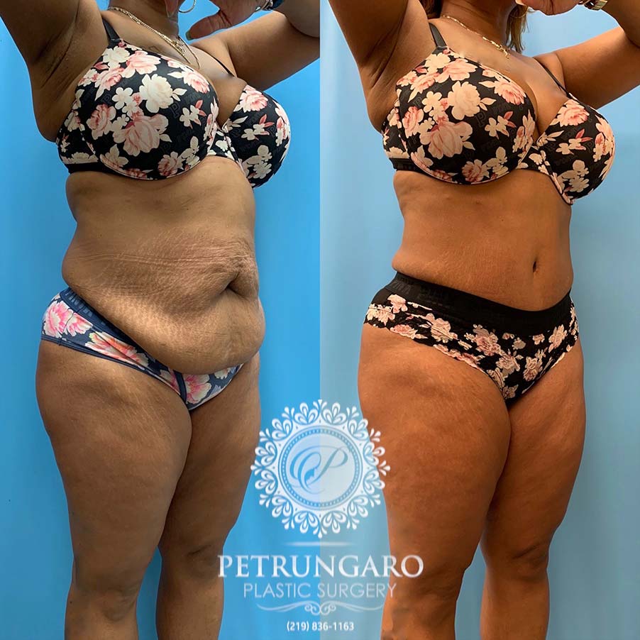 48 year old woman 4 months after Tummy Tuck with Lipo 360-6