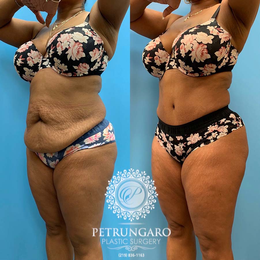 48 year old woman 4 months after Tummy Tuck with Lipo 360-7